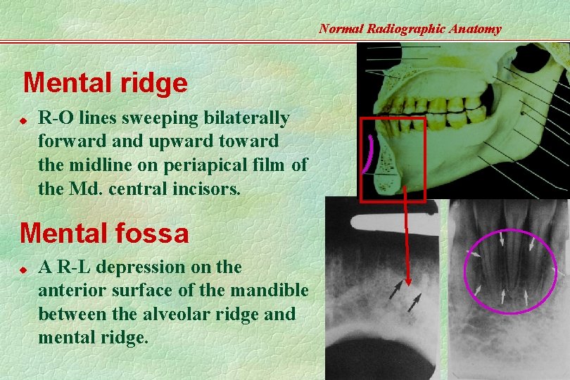 Normal Radiographic Anatomy Mental ridge u R-O lines sweeping bilaterally forward and upward toward