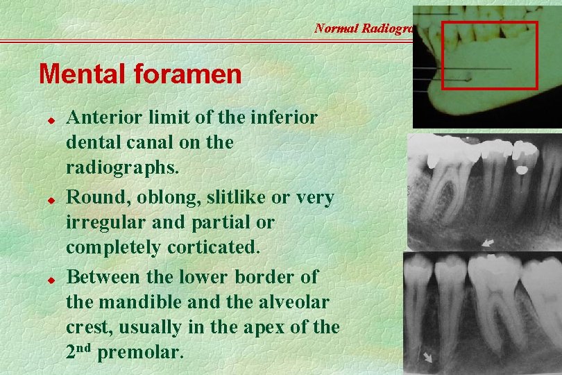Normal Radiographic Anatomy Mental foramen u u u Anterior limit of the inferior dental