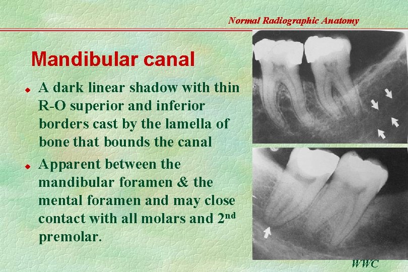 Normal Radiographic Anatomy Mandibular canal u u A dark linear shadow with thin R-O