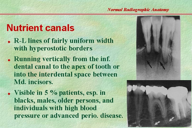 Normal Radiographic Anatomy Nutrient canals u u u R-L lines of fairly uniform width