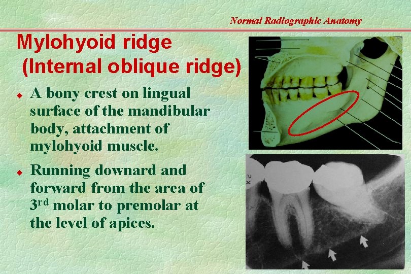 Normal Radiographic Anatomy Mylohyoid ridge (Internal oblique ridge) u u A bony crest on