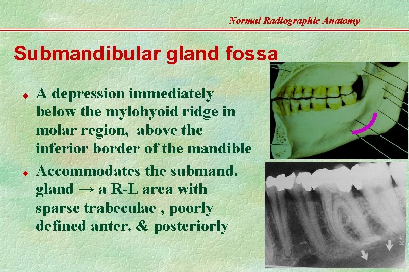 Normal Radiographic Anatomy Submandibular gland fossa u u A depression immediately below the mylohyoid