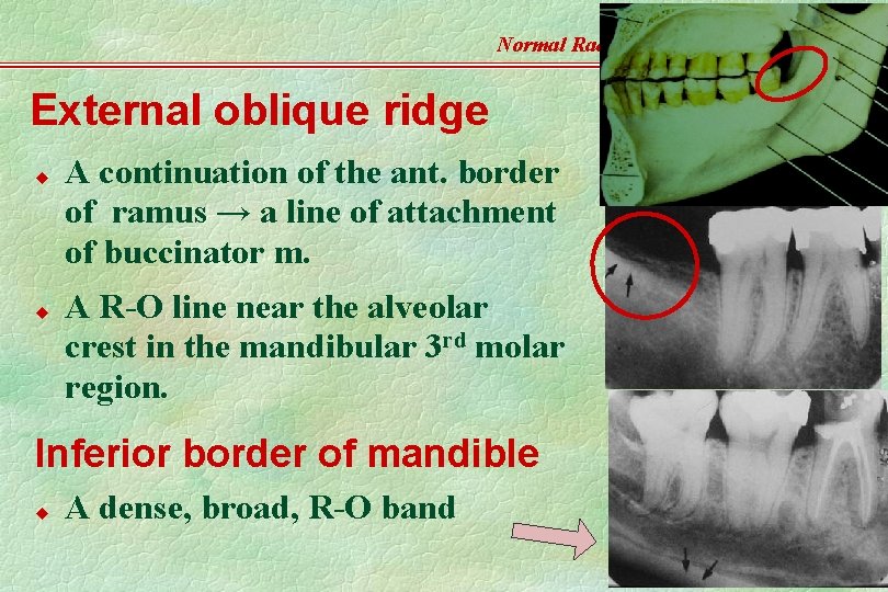Normal Radiographic Anatomy External oblique ridge u u A continuation of the ant. border