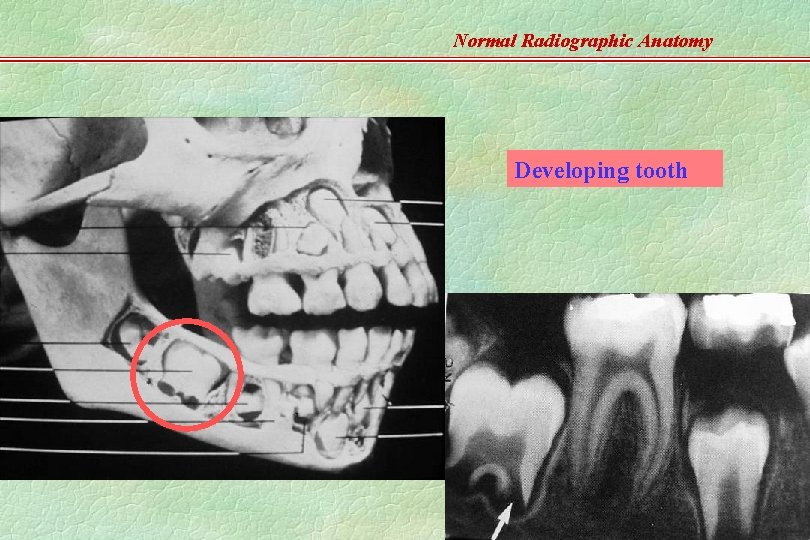 Normal Radiographic Anatomy Developing tooth WWC 