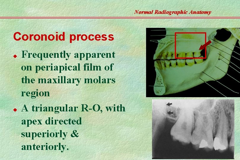 Normal Radiographic Anatomy Coronoid process u u Frequently apparent on periapical film of the
