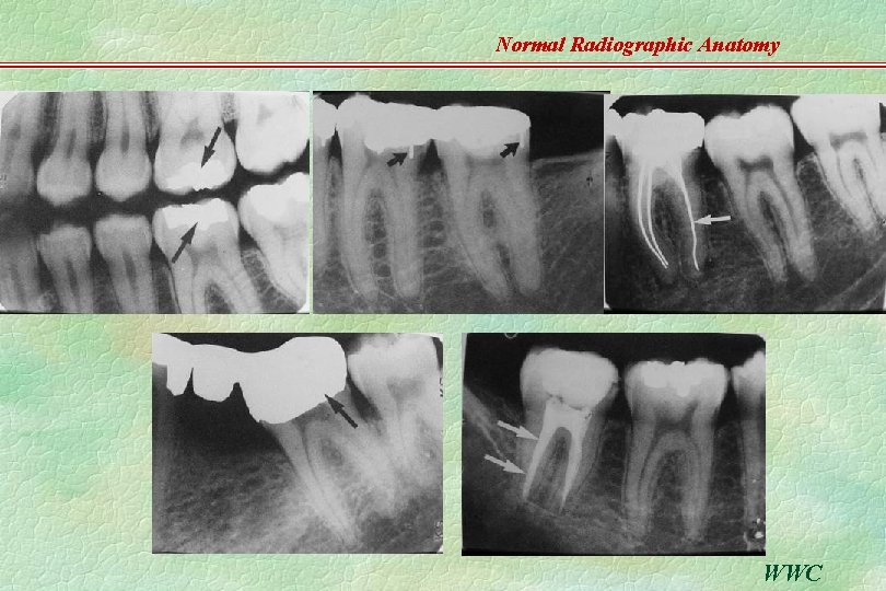 Normal Radiographic Anatomy WWC 