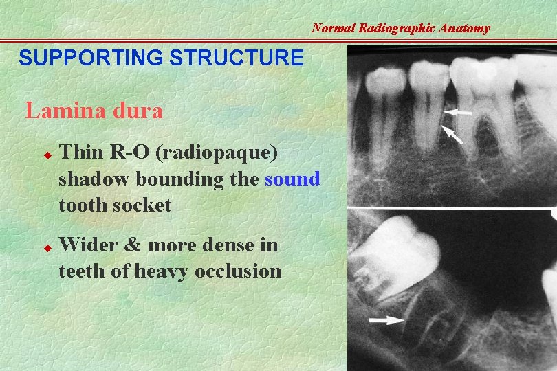 Normal Radiographic Anatomy SUPPORTING STRUCTURE Lamina dura u u Thin R-O (radiopaque) shadow bounding
