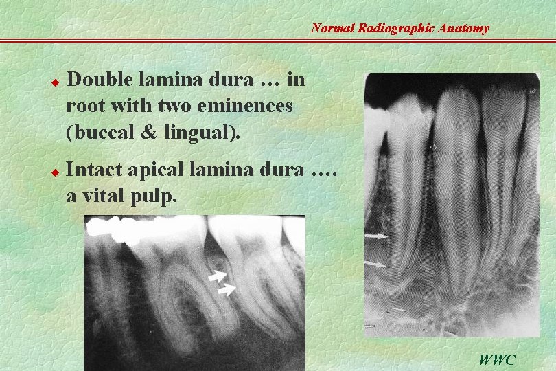 Normal Radiographic Anatomy u u Double lamina dura … in root with two eminences