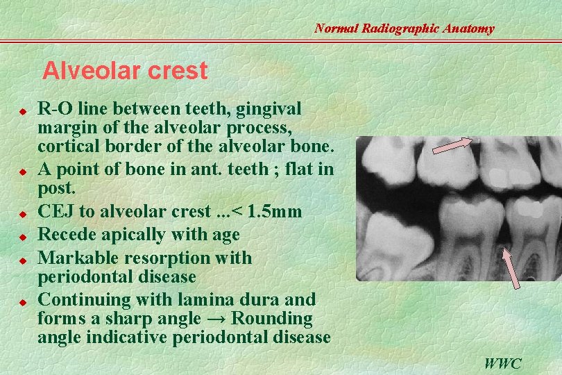 Normal Radiographic Anatomy Alveolar crest u u u R-O line between teeth, gingival margin