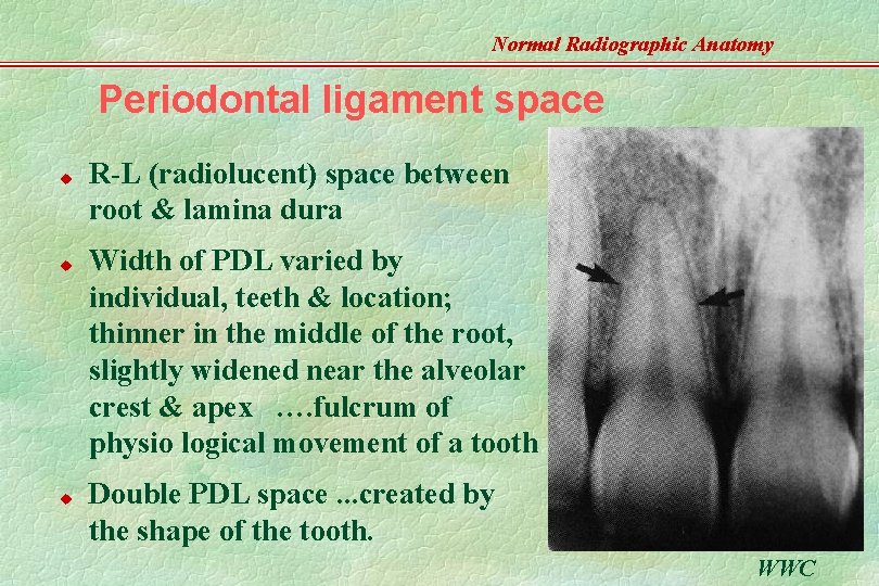 Normal Radiographic Anatomy Periodontal ligament space u u u R-L (radiolucent) space between root