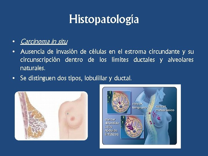 Histopatología • Carcinoma in situ • Ausencia de invasión de células en el estroma