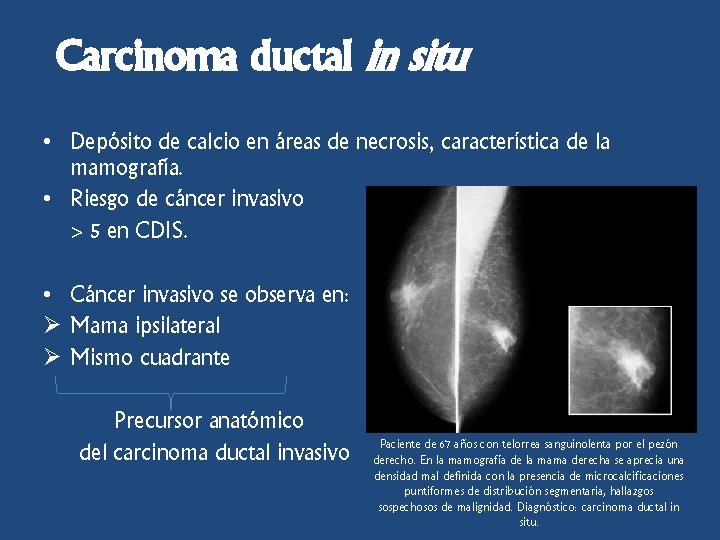 Carcinoma ductal in situ • Depósito de calcio en áreas de necrosis, característica de