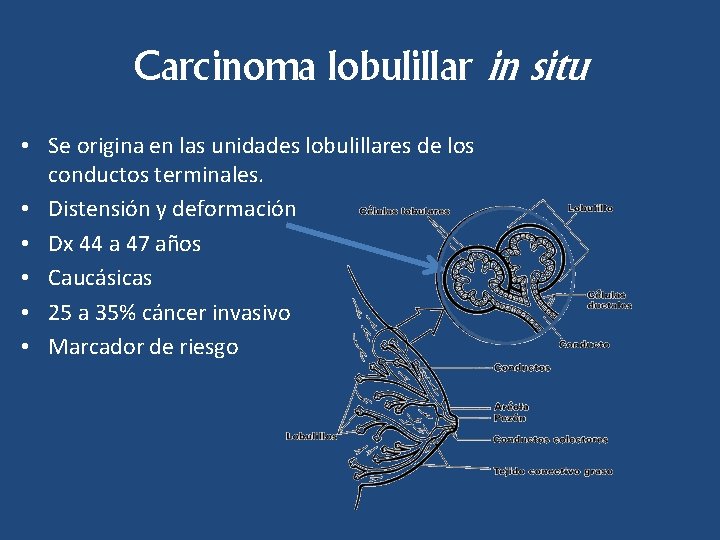 Carcinoma lobulillar in situ • Se origina en las unidades lobulillares de los conductos