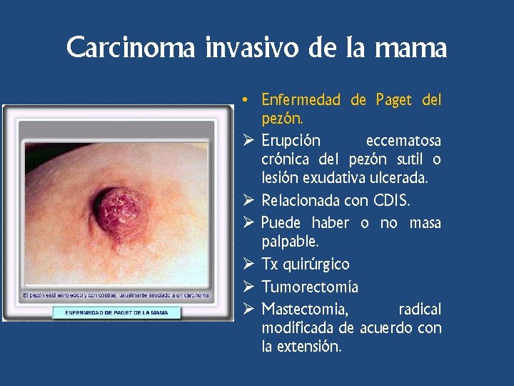 Carcinoma invasivo de la mama • Enfermedad de Paget del pezón. Ø Erupción eccematosa