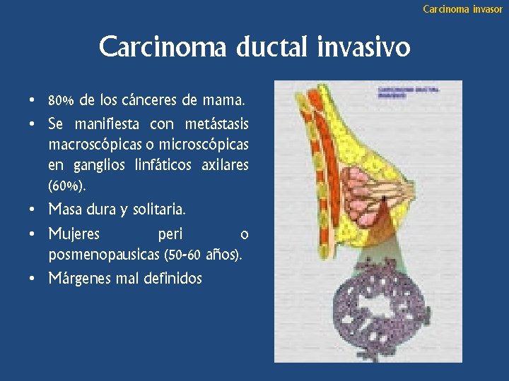 Carcinoma invasor Carcinoma ductal invasivo • 80% de los cánceres de mama. • Se