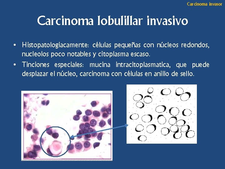 Carcinoma invasor Carcinoma lobulillar invasivo • Histopatologiacamente: células pequeñas con núcleos redondos, nucleolos poco