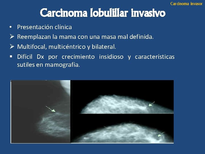 Carcinoma invasor Carcinoma lobulillar invasivo • Ø Ø § Presentación clínica Reemplazan la mama