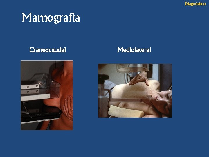 Diagnóstico Mamografía Craneocaudal Mediolateral 