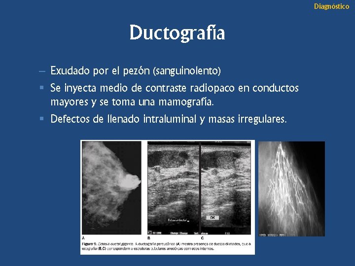 Diagnóstico Ductografía – Exudado por el pezón (sanguinolento) § Se inyecta medio de contraste