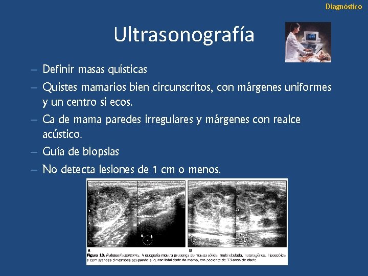 Diagnóstico Ultrasonografía – Definir masas quísticas – Quistes mamarios bien circunscritos, con márgenes uniformes