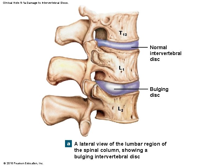 Clinical Note 9 -1 a Damage to Intervertebral Discs. T 12 Normal intervertebral disc Clinical Note 9 -1 a Damage to Intervertebral Discs. T 12 Normal intervertebral disc