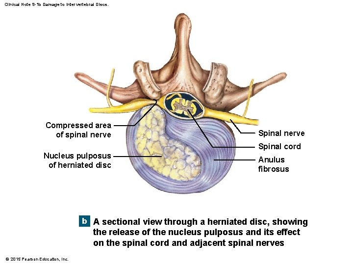 Clinical Note 9 -1 b Damage to Intervertebral Discs. Compressed area of spinal nerve Clinical Note 9 -1 b Damage to Intervertebral Discs. Compressed area of spinal nerve