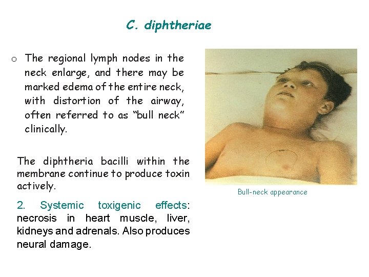 C. diphtheriae o The regional lymph nodes in the neck enlarge, and there may