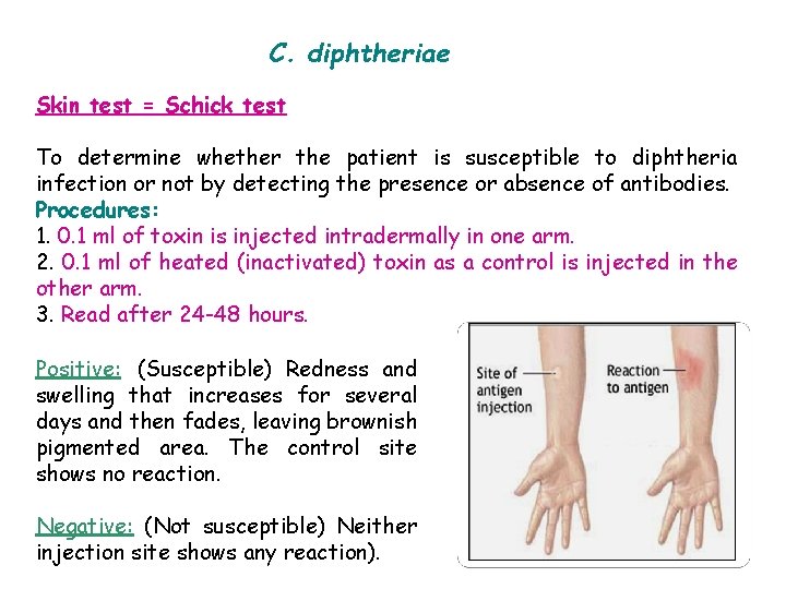 C. diphtheriae Skin test = Schick test To determine whether the patient is susceptible