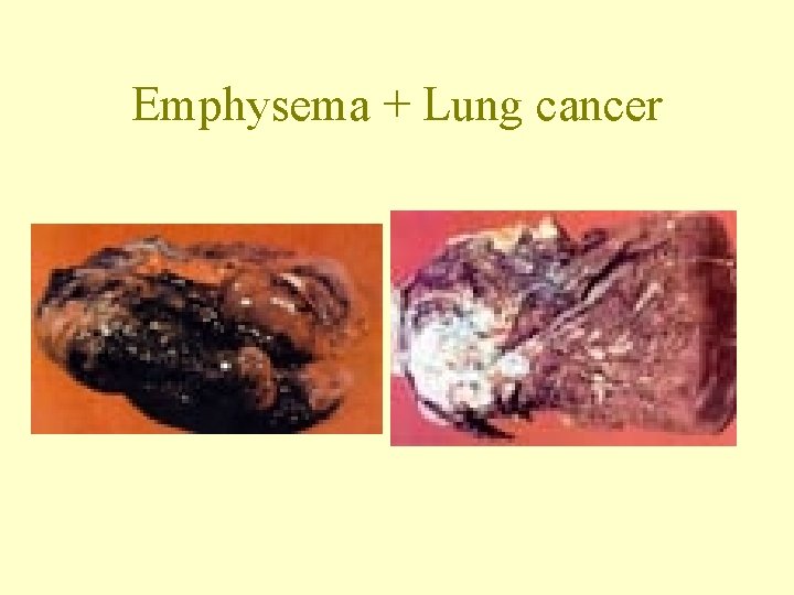 Emphysema + Lung cancer 