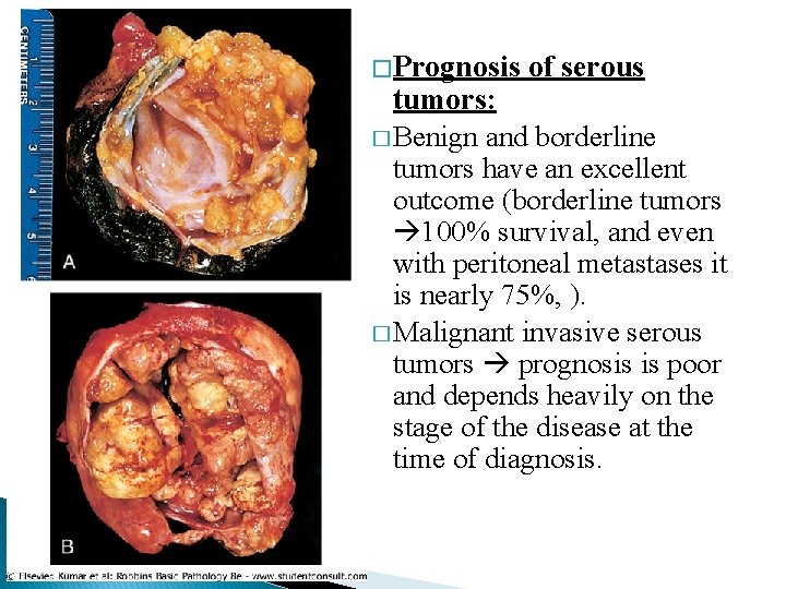 � Prognosis of serous tumors: � Benign and borderline tumors have an excellent outcome