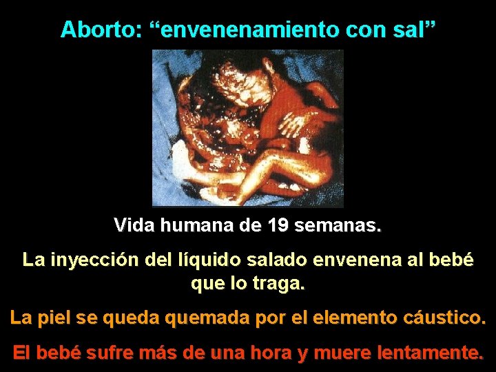 Aborto: “envenenamiento con sal” Vida humana de 19 semanas. La inyección del líquido salado