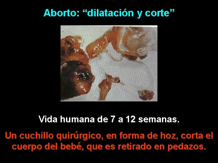 Aborto: “dilatación y corte” Vida humana de 7 a 12 semanas. Un cuchillo quirúrgico,