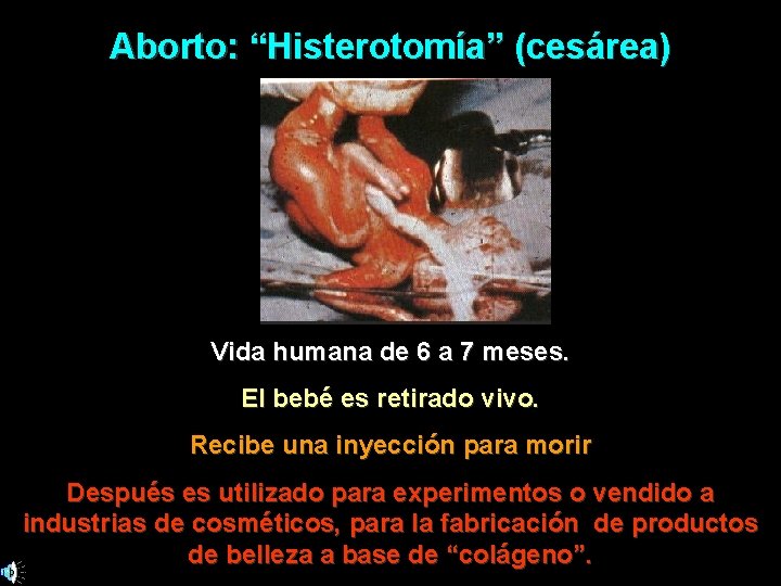 Aborto: “Histerotomía” (cesárea) Vida humana de 6 a 7 meses. El bebé es retirado