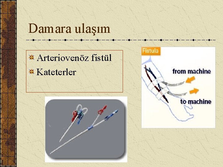 Damara ulaşım Arteriovenöz fistül Kateterler 