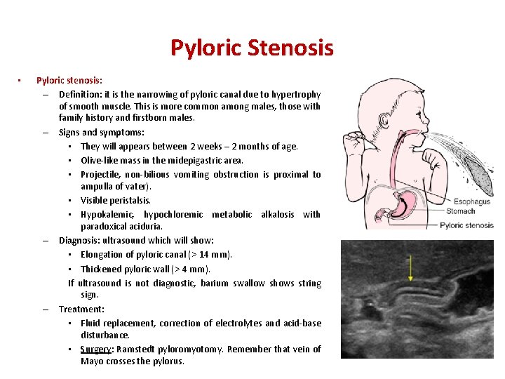 Pyloric Stenosis • Pyloric stenosis: – Definition: it is the narrowing of pyloric canal