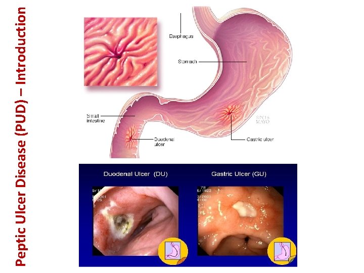 Peptic Ulcer Disease (PUD) – Introduction 