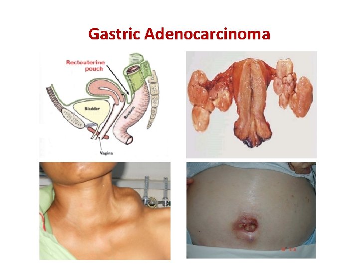 Gastric Adenocarcinoma 