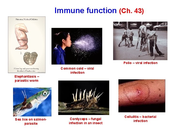 Immune function (Ch. 43) Polio – viral infection Common cold – viral infection Elephantiasis
