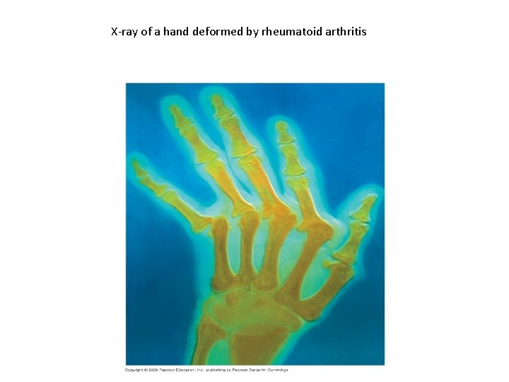 X-ray of a hand deformed by rheumatoid arthritis 