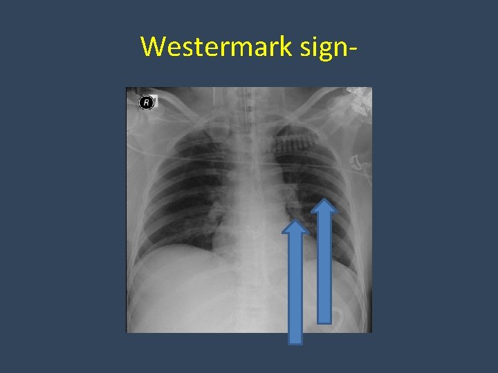 Westermark sign- 