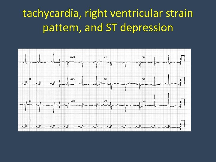 tachycardia, right ventricular strain pattern, and ST depression 