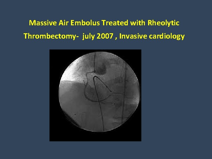 Massive Air Embolus Treated with Rheolytic Thrombectomy- july 2007 , Invasive cardiology 