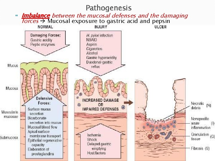 Pathogenesis Imbalance between the mucosal defenses and the damaging forces Mucosal exposure to gastric