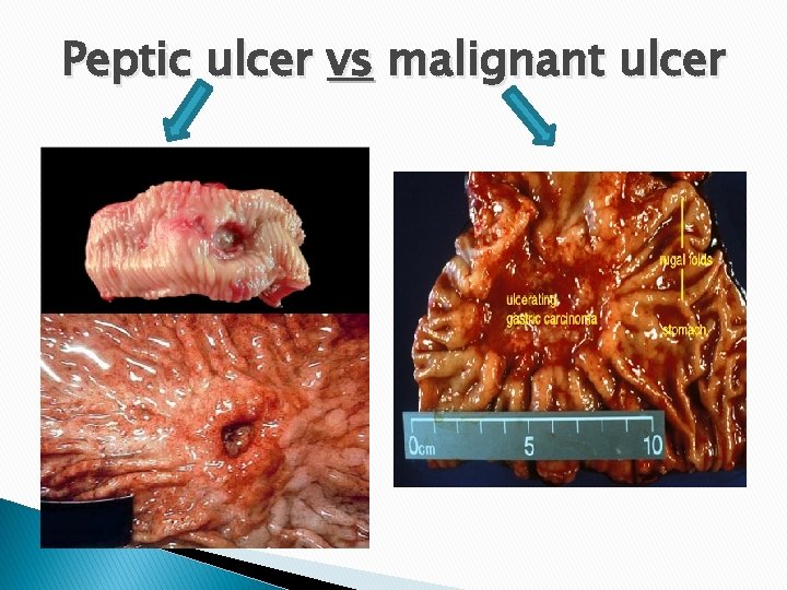 Peptic ulcer vs malignant ulcer 