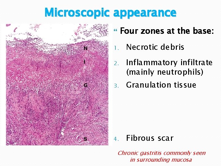 Microscopic appearance Four zones at the base: 1. Necrotic debris 2. Inflammatory infiltrate (mainly