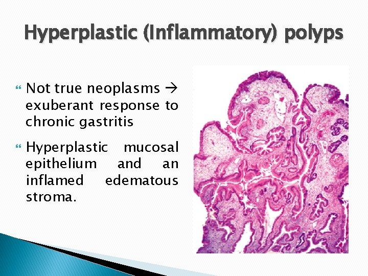 Hyperplastic (Inflammatory) polyps Not true neoplasms exuberant response to chronic gastritis Hyperplastic mucosal epithelium