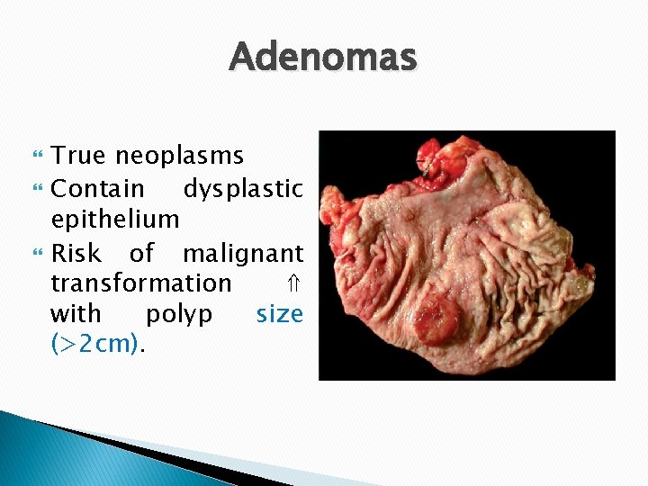 Adenomas True neoplasms Contain dysplastic epithelium Risk of malignant transformation ⇑ with polyp size