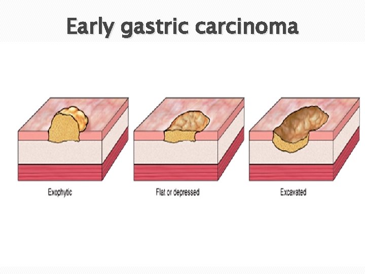 Early gastric carcinoma 