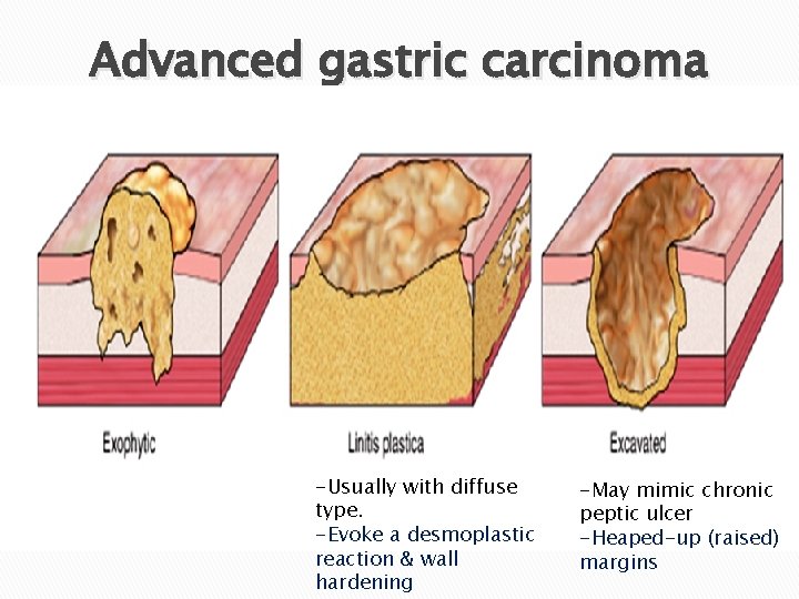 Advanced gastric carcinoma -Usually with diffuse type. -Evoke a desmoplastic reaction & wall hardening