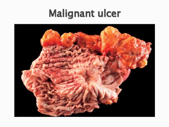 Malignant ulcer 